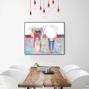 Impression sur toile implant dentaire