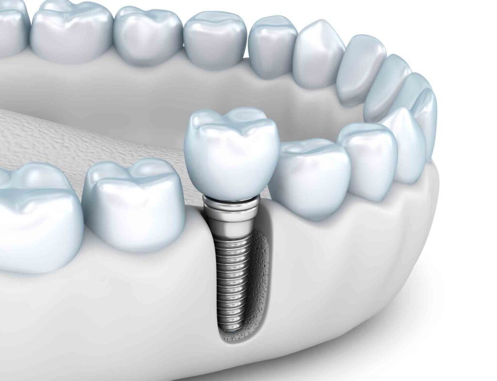 Remboursement implants dentaires en France recommandation HAS
