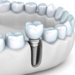 Remboursement implants dentaires en France recommandation HAS
