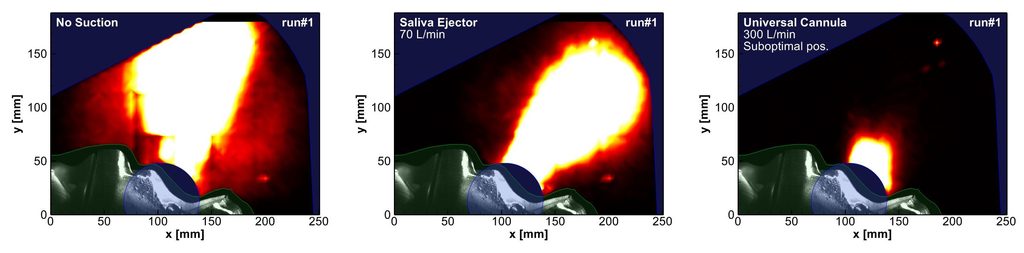 Dispersion de l’aérosol sans aspiration, avec une pompe à salive et avec une canule d’aspiration à 300 L/min